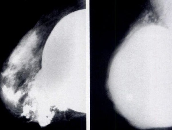 Florida Woman Sues Imaging Center After Breast Implant Crushed During Mammogram