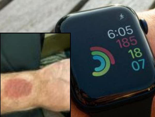 Apple Watch Wrist Burn Results In Florida Lawsuit