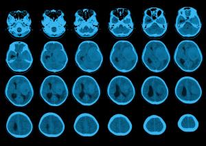 Birth Control Alert: Growing Number of Depo-Provera Brain Tumor Lawsuits Are Now Centralized in a Florida Court